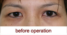 plastic-surgery-blepharoplasty